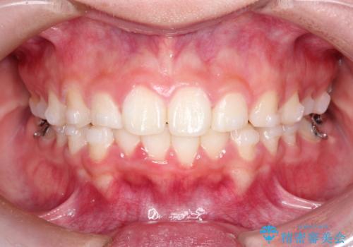 【インビザライン】出っ歯を引っ込めたい。の治療中