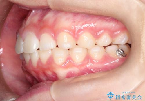 【インビザライン】出っ歯を引っ込めたい。の治療中