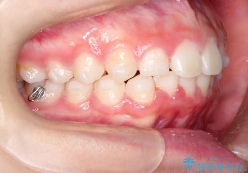 【インビザライン】出っ歯を引っ込めたい。の治療中