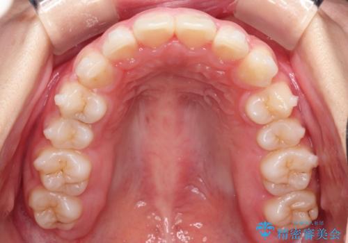 【インビザライン】出っ歯を引っ込めたい。の治療中