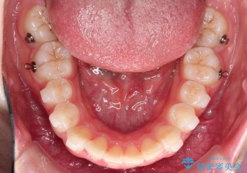 【インビザライン】出っ歯を引っ込めたい。の治療中