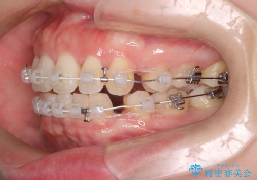 【審美装置】癒合歯がある方の治療の治療中