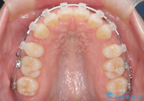 【審美装置】癒合歯がある方の治療の治療中