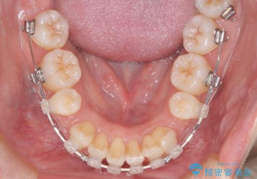 【審美装置】癒合歯がある方の治療の治療中