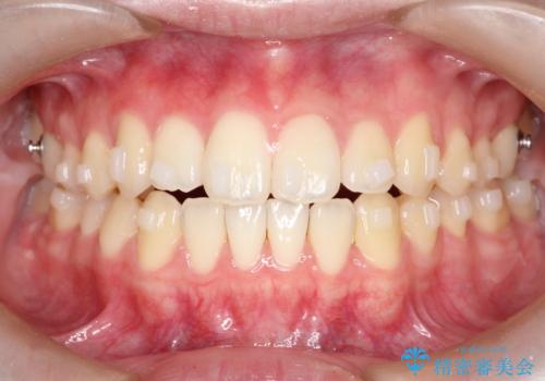 【インビザライン】前歯のガタガタをなおしたいの治療中