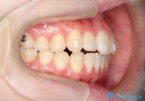 【インビザライン】前歯のガタガタをなおしたいの治療中