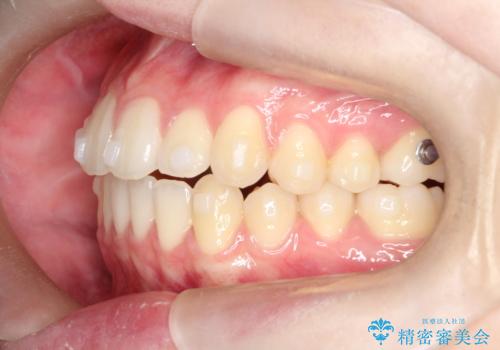 【インビザライン】前歯のガタガタをなおしたいの治療中
