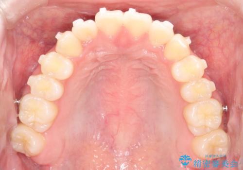 【インビザライン】前歯のガタガタをなおしたいの治療中