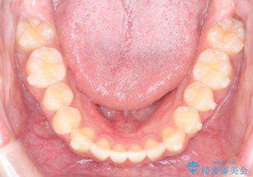 【インビザライン】前歯のガタガタをなおしたいの治療中