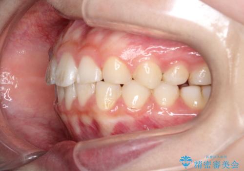 【インビザライン】出っ歯を引っ込めたい。の治療後