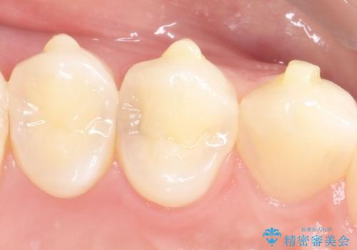 【セラミックインレー】歯と歯の間の虫歯治療の症例 治療前