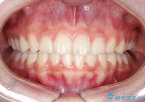 【インビザライン】出っ歯を引っ込めたい。の症例 治療後