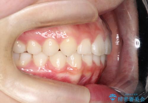 【インビザライン】出っ歯を引っ込めたい。の治療後