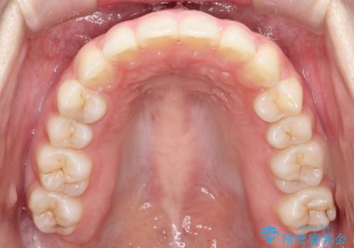 【インビザライン】出っ歯を引っ込めたい。の治療後