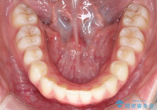 【インビザライン】出っ歯を引っ込めたい。の治療後