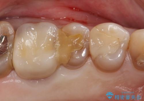 【MTAを用いた生活歯髄療法】神経に到達する深い虫歯の治療前