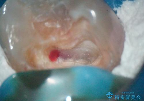 【MTAを用いた生活歯髄療法】神経に到達する深い虫歯の治療中