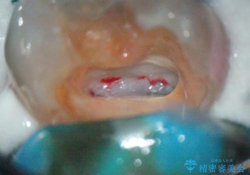 【MTAを用いた生活歯髄療法】神経に到達する深い虫歯の治療後