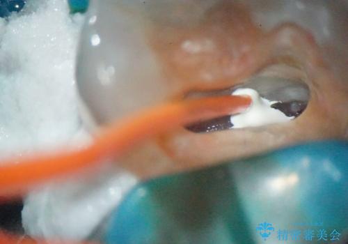 【MTAを用いた生活歯髄療法】神経に到達する深い虫歯の治療前