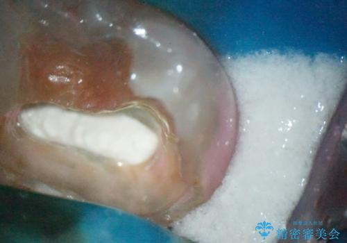 【MTAを用いた生活歯髄療法】神経に到達する深い虫歯の治療中