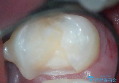【セラミックインレー】歯と歯の間の虫歯治療