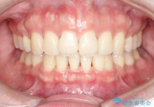 【審美装置】癒合歯がある方の治療の症例 治療後