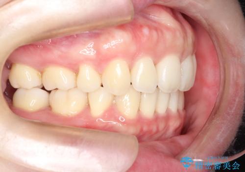 【審美装置】癒合歯がある方の治療の治療後