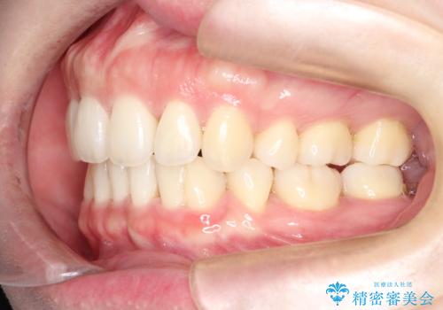 【審美装置】癒合歯がある方の治療の治療後