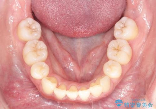 【審美装置】癒合歯がある方の治療の治療後