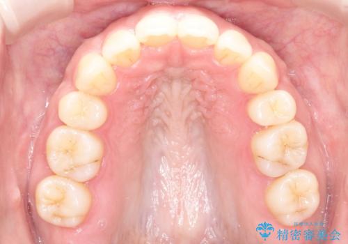 【審美装置】癒合歯がある方の治療の治療後