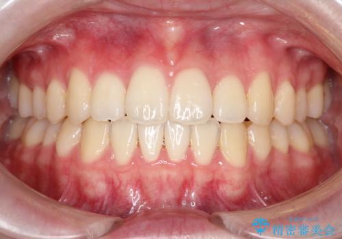 【インビザライン】前歯のガタガタをなおしたいの症例 治療後