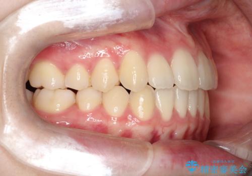 【インビザライン】前歯のガタガタをなおしたいの治療後