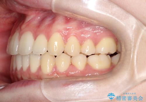 【インビザライン】前歯のガタガタをなおしたいの治療後