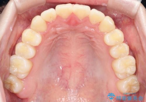【インビザライン】前歯のガタガタをなおしたいの治療後