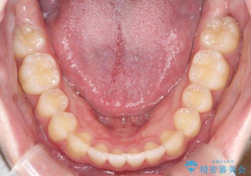 【インビザライン】前歯のガタガタをなおしたいの治療後