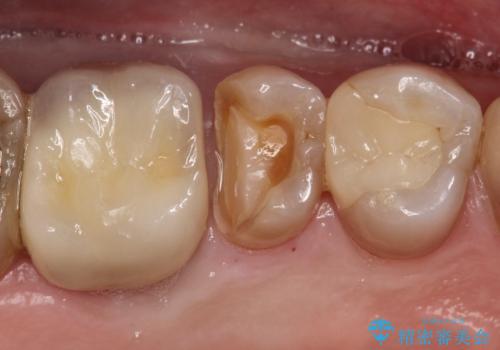 【MTAを用いた生活歯髄療法】神経に到達する深い虫歯の治療中