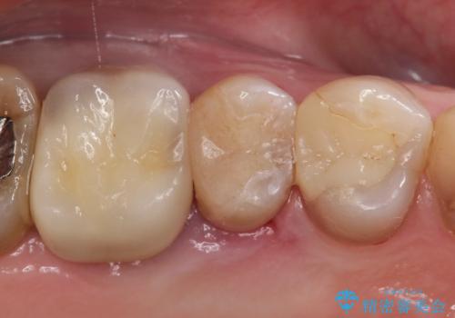 【MTAを用いた生活歯髄療法】神経に到達する深い虫歯の症例 治療後