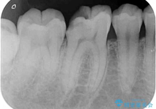 放置してしまった虫歯の治療の治療前