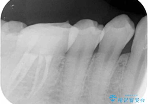 放置してしまった虫歯の治療の治療中