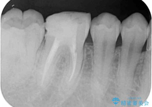 放置してしまった虫歯の治療の治療中