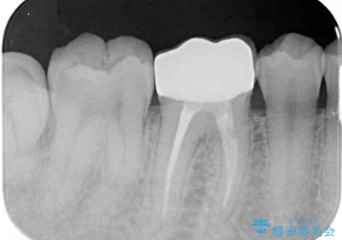 放置してしまった虫歯の治療の治療後