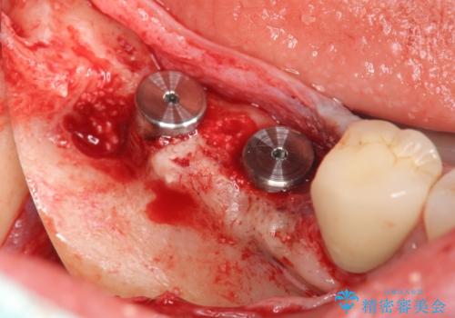 臼歯部インプラント治療の治療中