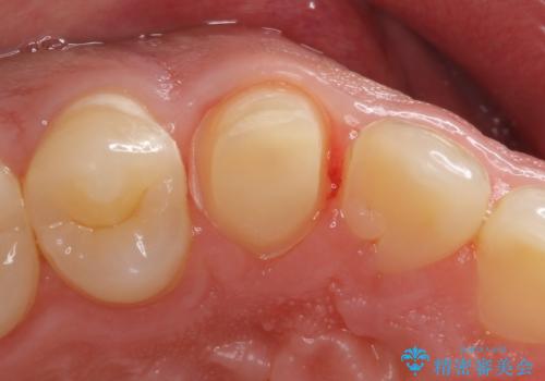 穴が開いた前歯 白いクラウンで修復の治療中