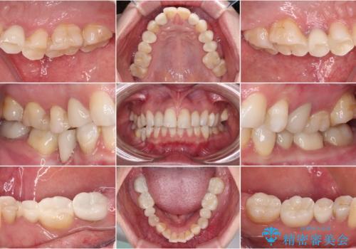 金属の見えてしまったクラウン セラミッククラウンで自然にの治療後