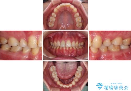 部分矯正を併用した奥歯のインプラント治療の治療後