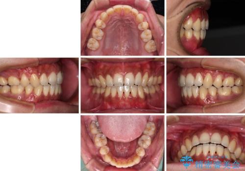隙間が空いて突出した前歯を治したい ワイヤー装置による抜歯矯正の治療後