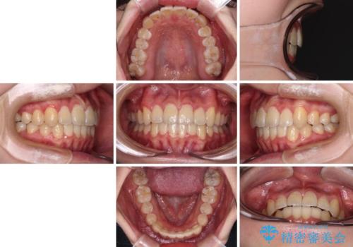 【モニター】八重歯と前歯のクロスバイト　ワイヤーを併用しインビザラインで矯正治療の治療後