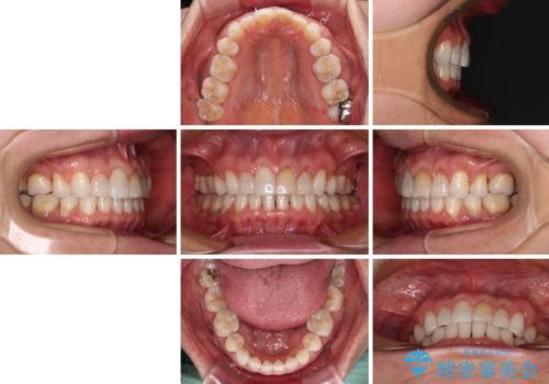 矯正治療の後戻り インビザライン・ライトでの再矯正の治療後