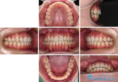 急速拡大装置 狭い上顎骨を拡大してワイヤー装置で短期間治療の治療後