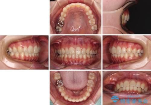 転勤予定がある インビザラインによる矯正治療の治療後